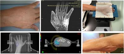 Considerations on surgery invasiveness and response and toxicity patterns in classic palliative radiotherapy for acrometastases of the hand: a hint for a potential role of stereotactic body radiation therapy? A case report and literature review